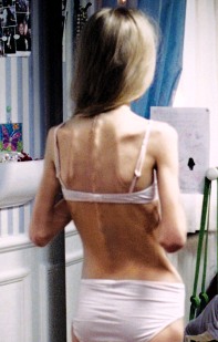 allarme-anoressia-tra-le-adolescenti