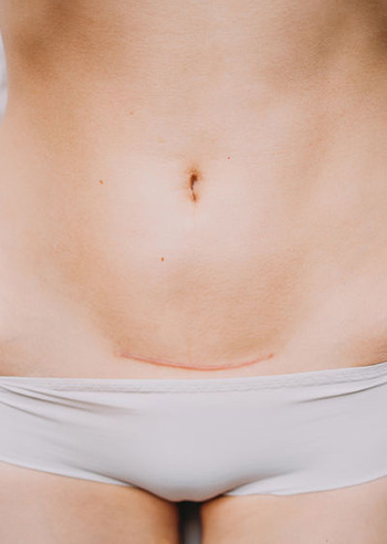 55872819 - closeup of woman belly with a scar from a cesarean section