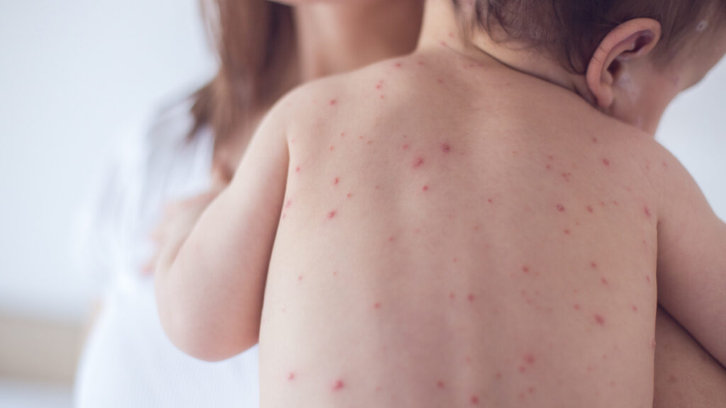 Mother taking care of baby with chicken pox