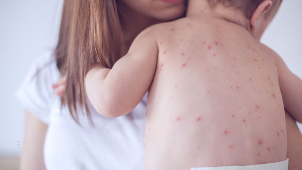 morbillo perche vaccinare i bambini